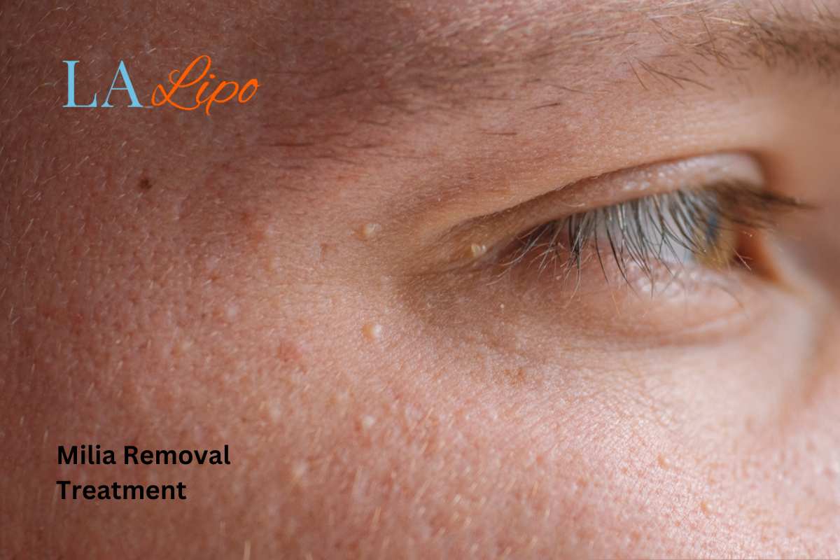 Cryopen Milia Removal: Is It the Easiest and Safest Option King's Norton?