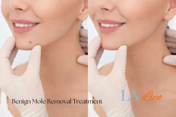 woman's before and after mole removal King's Norton results