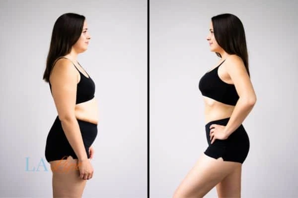 image of woman before and after results of LA-EMS Body Sculpting King's Norton to help treat Diastasis recti