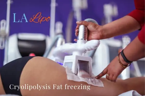 women getting fat freezing King's Norton