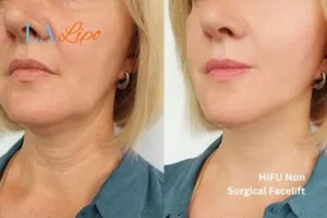 hi-fu for wrinkles King's Norton before and after results