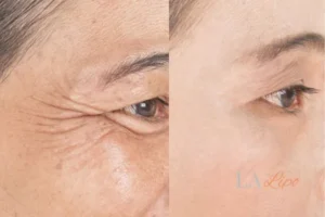 Before and after results of woman - HI-fu wrinkles reduction treatment King's Norton