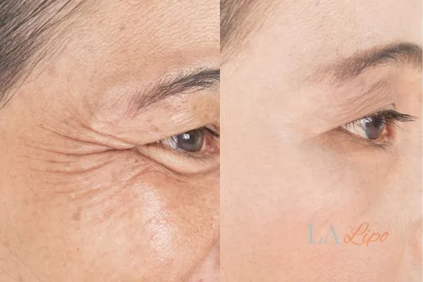 Before and after results of woman - HI-fu wrinkles reduction treatment King's Norton