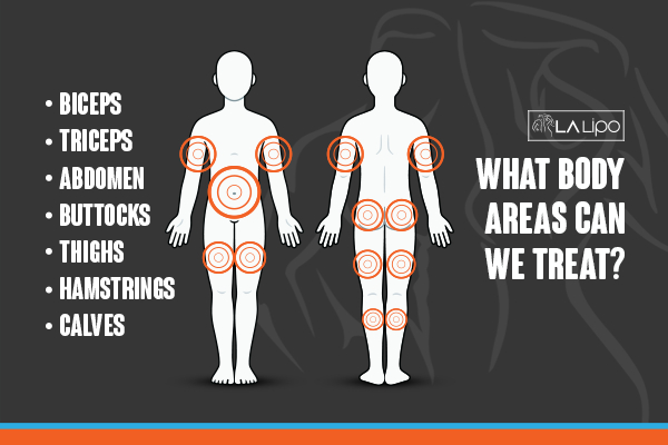 Graphic to show areas you can have LA-EMS Body Sculpting King's Norton treatment.