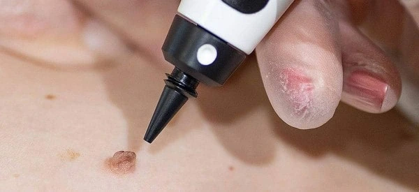 skin tag removal using cryopen King's Norton