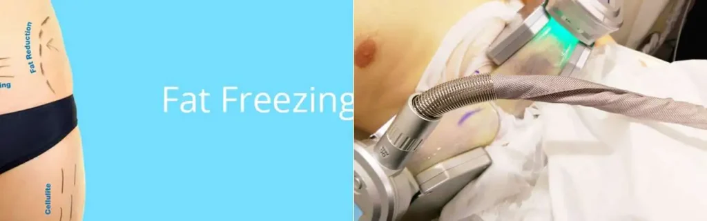 Fat freezing King's Norton on multiple areas of the body
