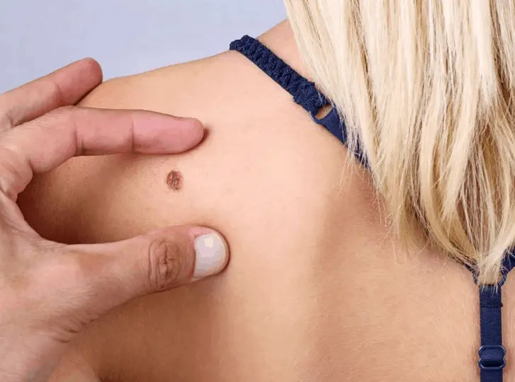 woman having mole removal King's Norton consultation before treatment.