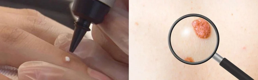 CryoPen practitioner King's Norton assessing a benign mole before treatment