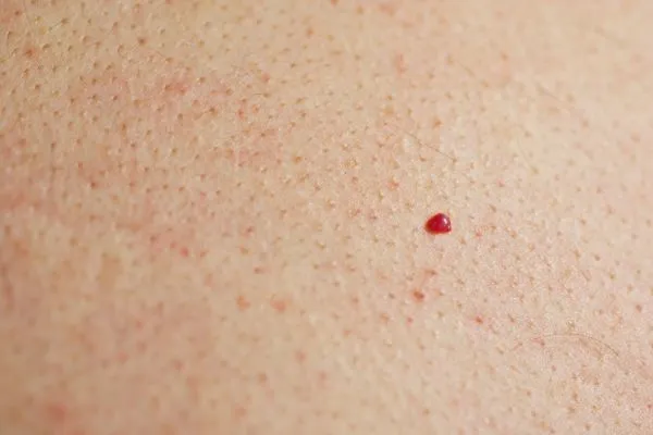 close up of a cherry angioma King's Norton