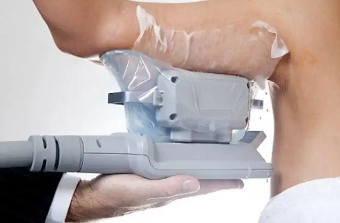 Picture of fat freezing King's Norton on the upper arms.