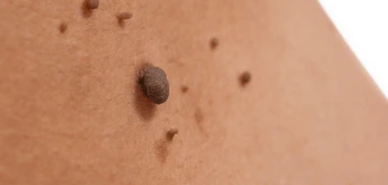 image of a skin tag King's Norton