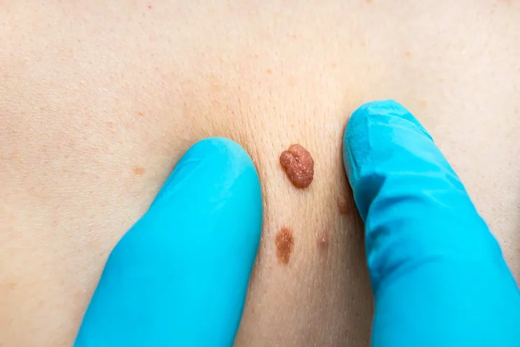 Consultant examining a skin tag King's Norton