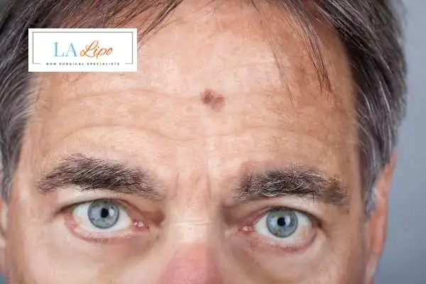 Solar Lentigo Removal King's Norton image of man with mark on his forehead