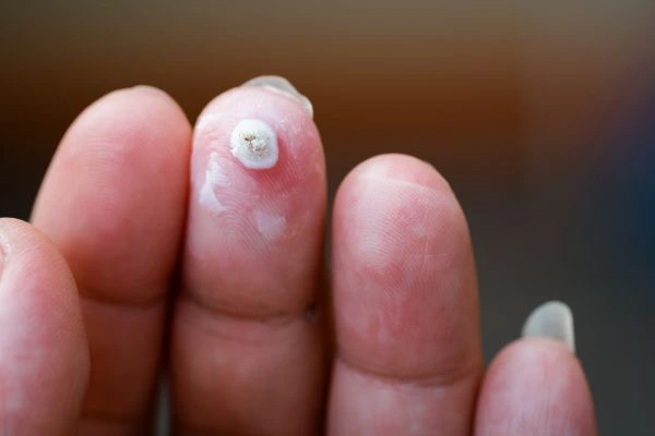 wart on person finger - cryotherapy to treat from LA LIPO King's Norton