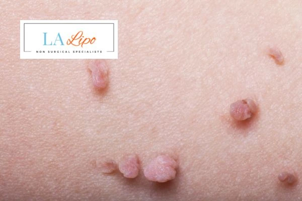 Does cryopen skin tag removal King's Norton hurt? Find out now call our team today!