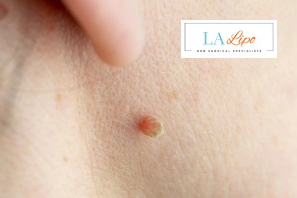 Book skin tag removal King's Norton today speak to our team now!