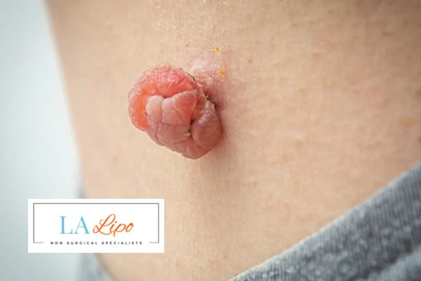 Interested in skin tag removal King's Norton? Concerned about the pain? Find out more today!