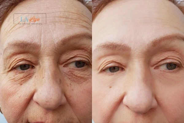 The powerful benefits of Morpheus8 Treatment King's Norton - Call Our team today!