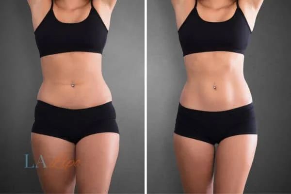 before and after results of non-surgical treatment to help a woman's body image and mental health King's Norton