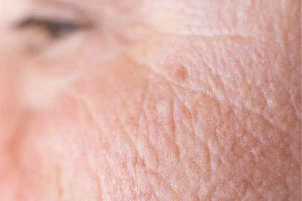 close up picture of a woman's face showing an age spot King's Norton