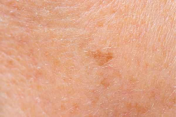 close up picture of age spots King's Norton