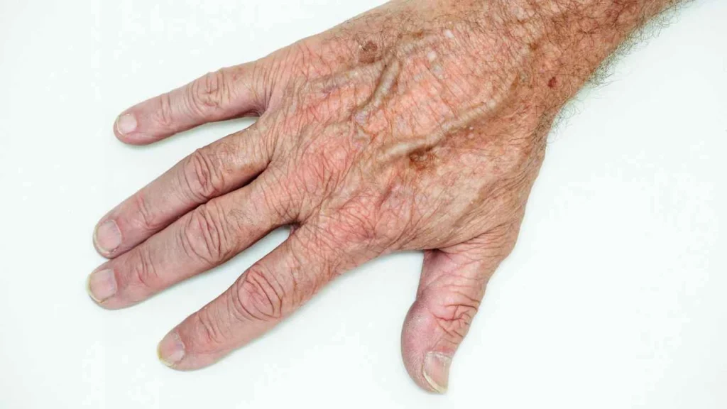 Male hand showing age spot King's Norton