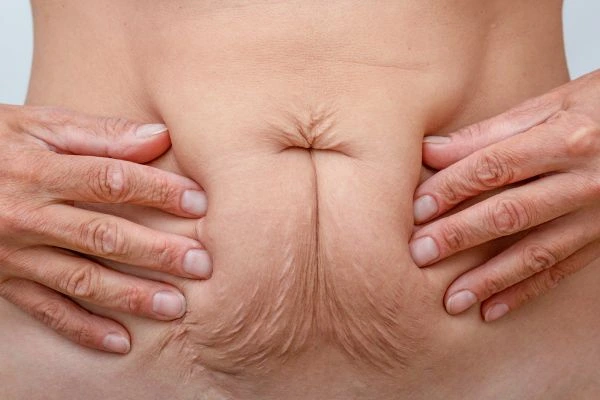Image of a woman's stomach with loose skin - example of skin tightening King's Norton options