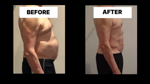 What Symptoms Can Diastasis Recti Cause in Men? Weak Core, Back Pain and Poor Posture King's Norton